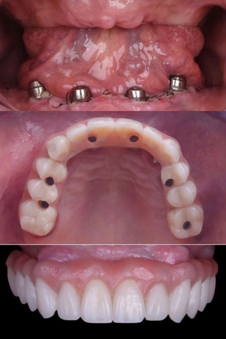 Full Mouth Rehabilitation